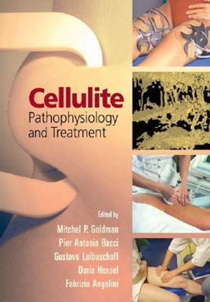 Cellulite: Pathophysiology and Treatment image number 0