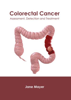Colorectal Cancer: Assessment, Detection and Treatment image number 0