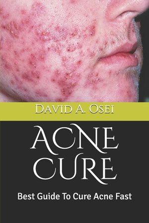 Acne Cure: Best Guide To Cure Acne Fast image number 0