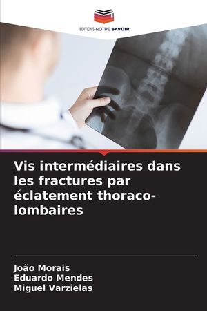 Vis interm&eacute;diaires dans les fractures par &eacute;clatement thoraco-lombaires image number 0