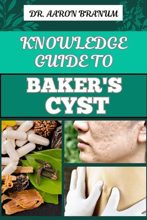 Knowledge Guide to Baker's Cyst: Essential Manual To Symptoms, Diagnosis, Treatment Options, And Prevention For Optimal Knee Health image number 0