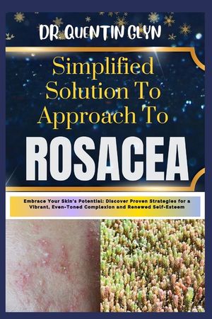 Simplified Solution Approach To ROSACEA: Embrace Your Skin's Potential: Discover Proven Strategies for a Vibrant, Even-Toned Complexion and Renewed Se image number 0
